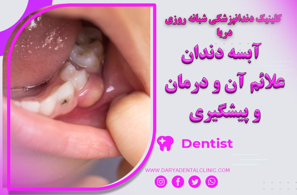 آبسه دندان ( علائم آن و درمان و پیشگیری )