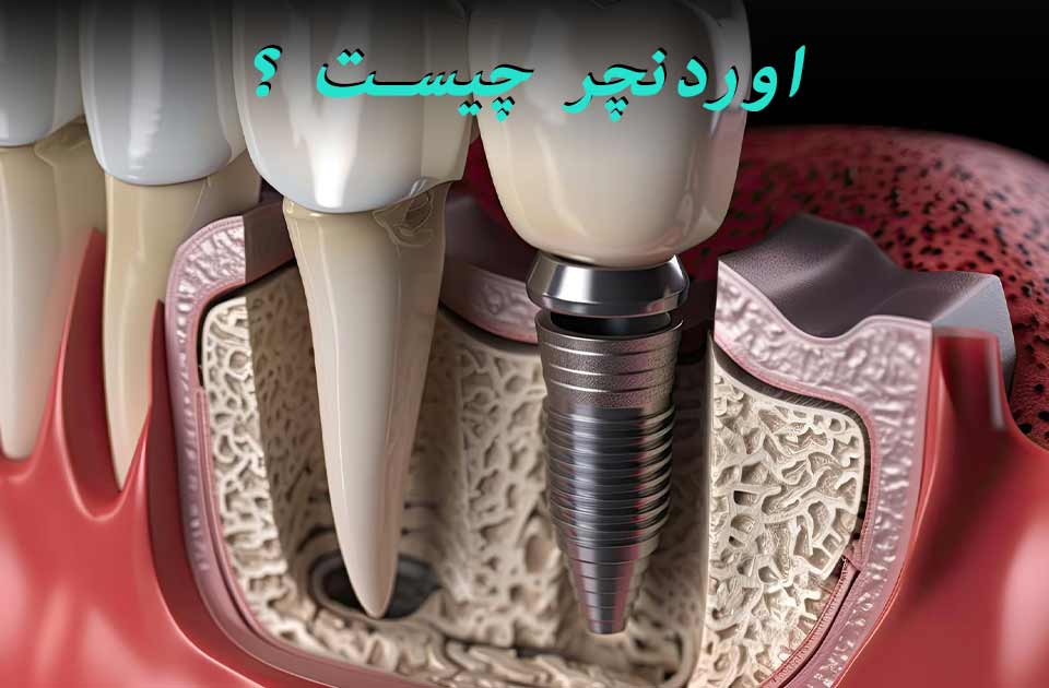 اوردنچر چیست ؟