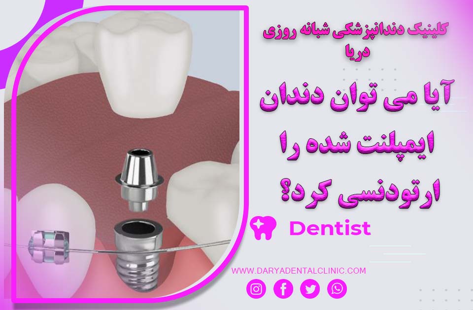 آیا می توان دندان ایمپلنت شده را ارتودنسی کرد ؟