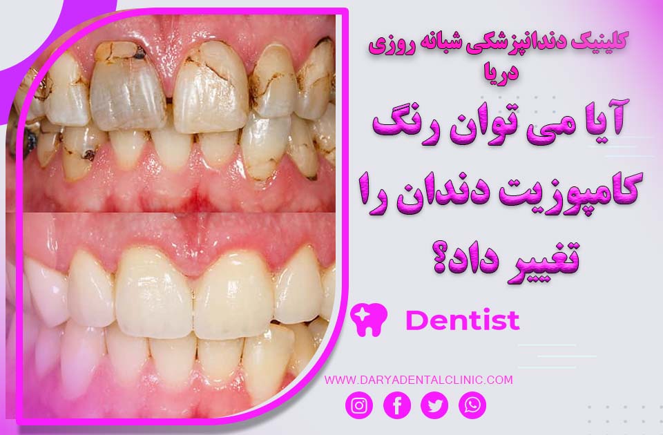 آیا می‌توان رنگ کامپوزیت دندان را تغییر داد؟