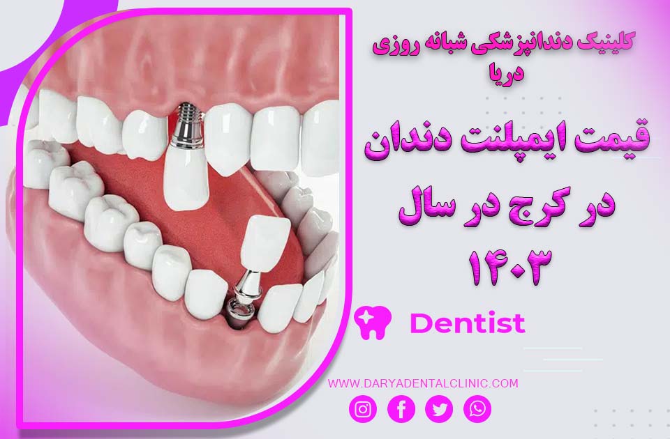 قیمت ایمپلنت دندان در کرج در سال جدید ( 1404 )
