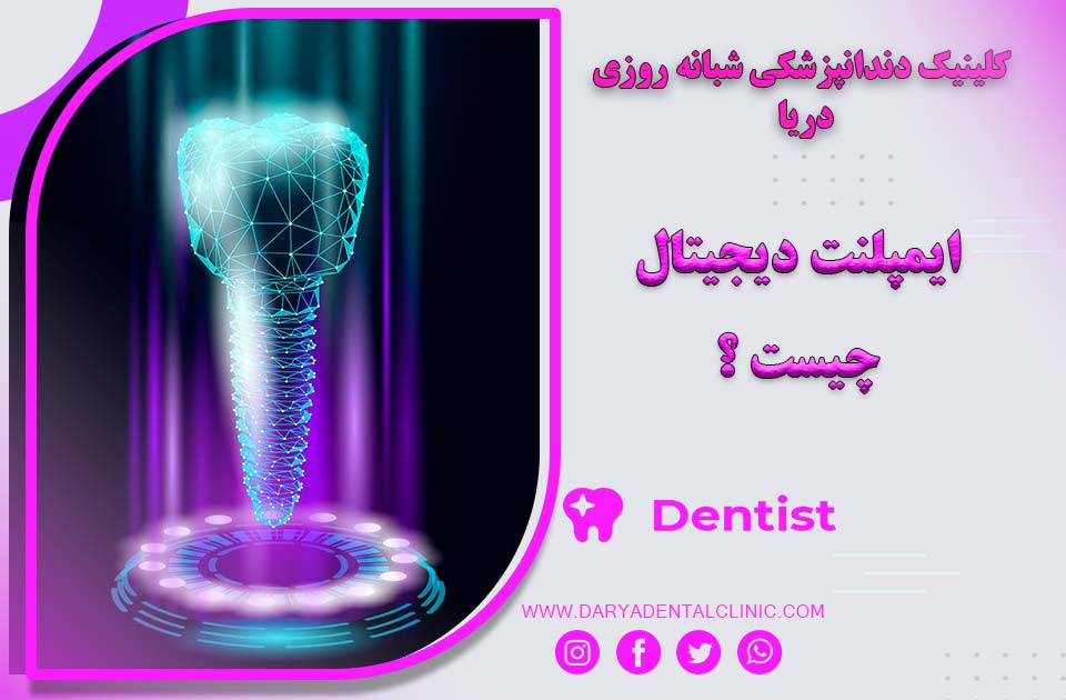 ایمپلنت دیجیتال چیست ؟