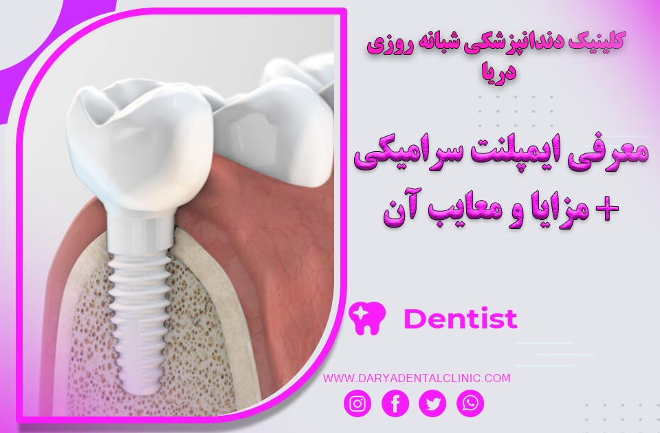 معرفی ایمپلنت سرامیکی + مزایا و معایب آن