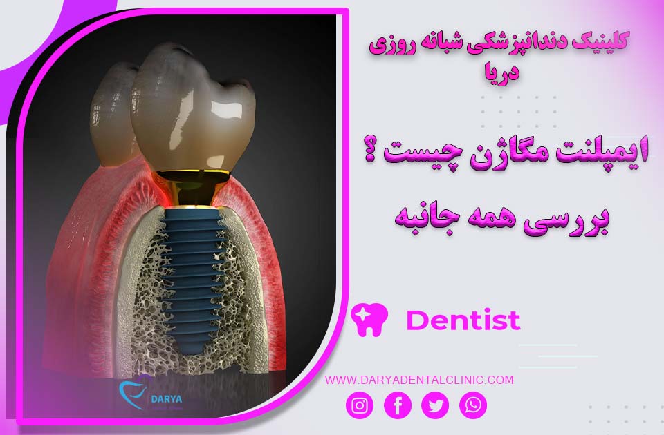 ایمپلنت مگاژن چیست ؟ بررسی همه جانبه