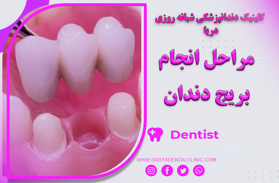 مراحل انجام بریج دندان ( راهنمای جامع و کامل )