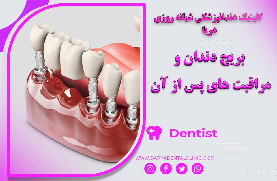 بریج دندان و مراقبت‌های پس از آن چگونه است ؟