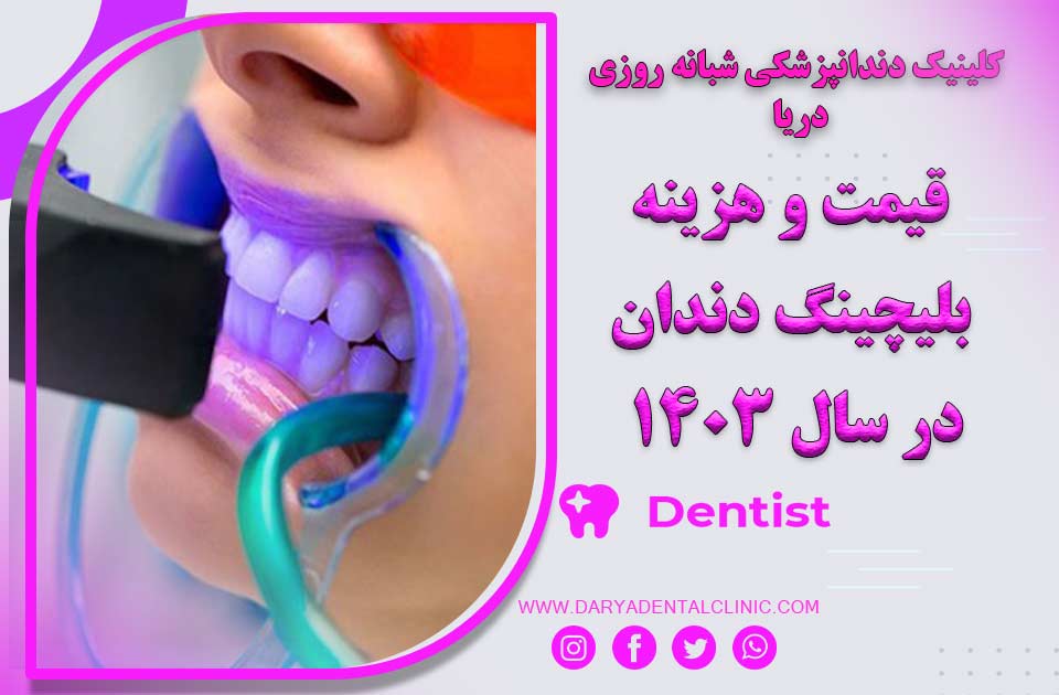 قیمت و هزینه بلیچینگ دندان در سال 1404 در کرج