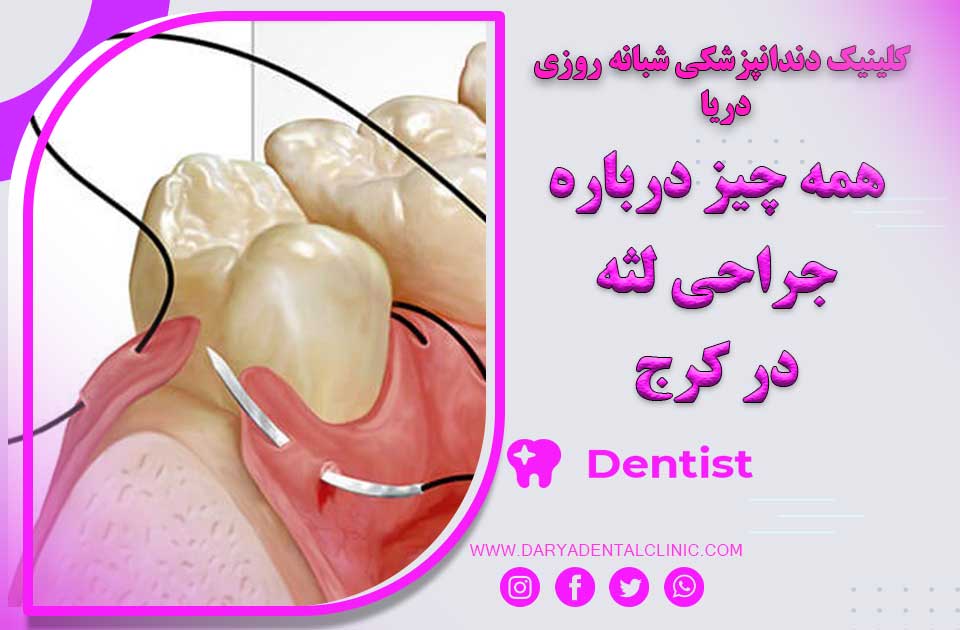 همه چیز درباره جراحی لثه در کرج