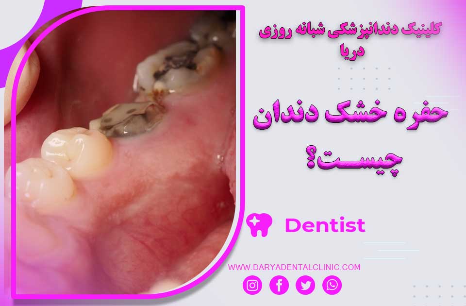 حفره خشک دندان چیست ؟