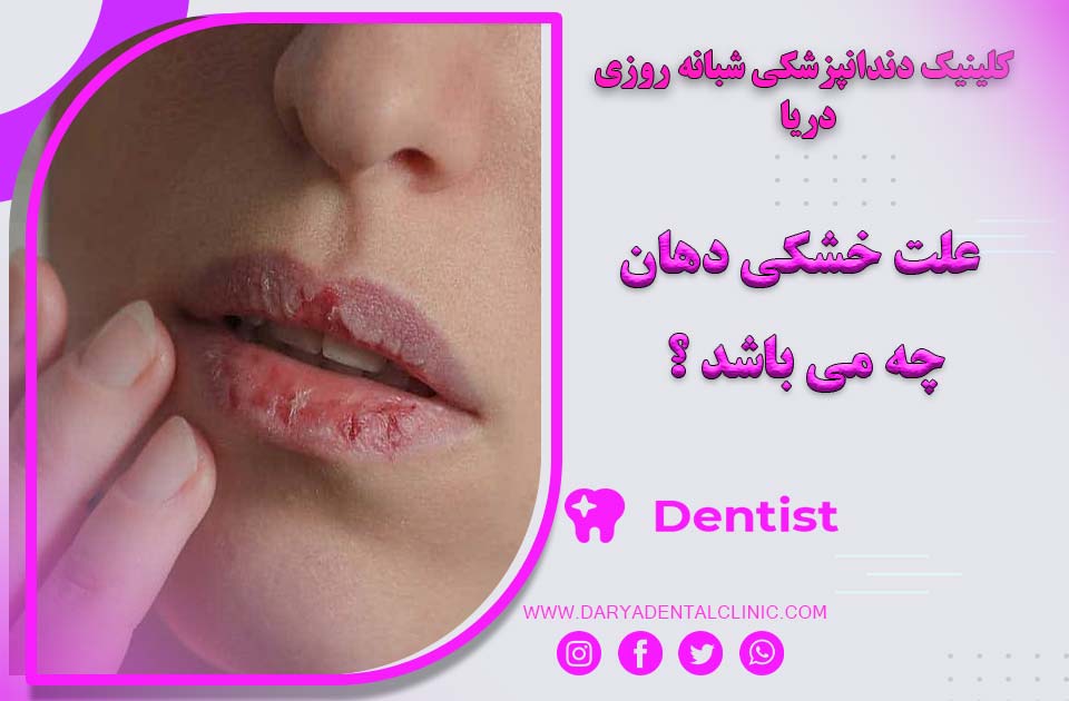 علت خشکی دهان چه می باشد ؟