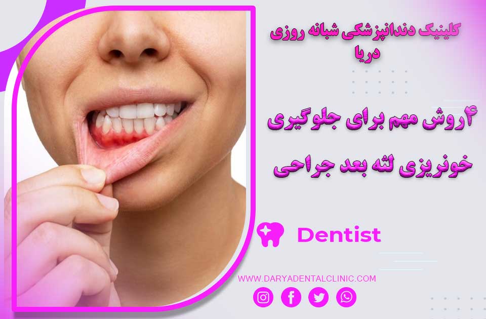 4 روش مهم برای جلوگیری خونریزی لثه بعد از جراحی