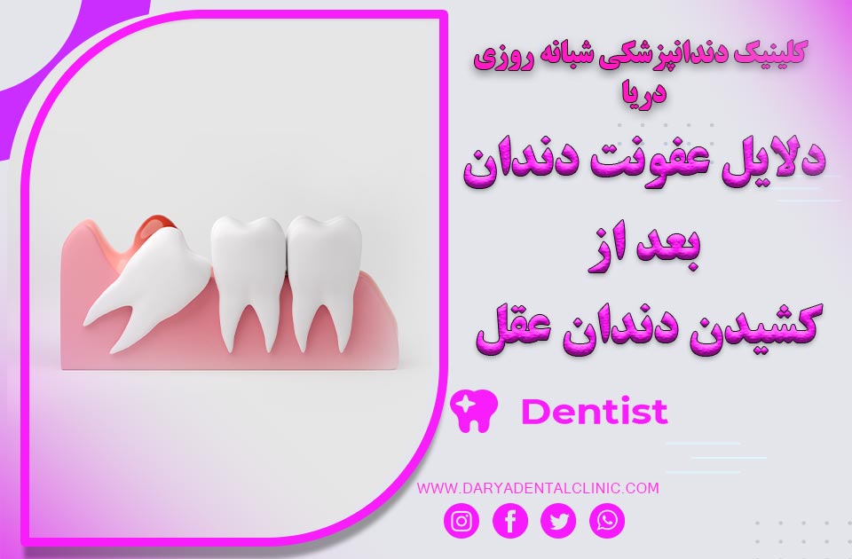 دلایل عفونت دندان بعد از کشیدن دندان عقل