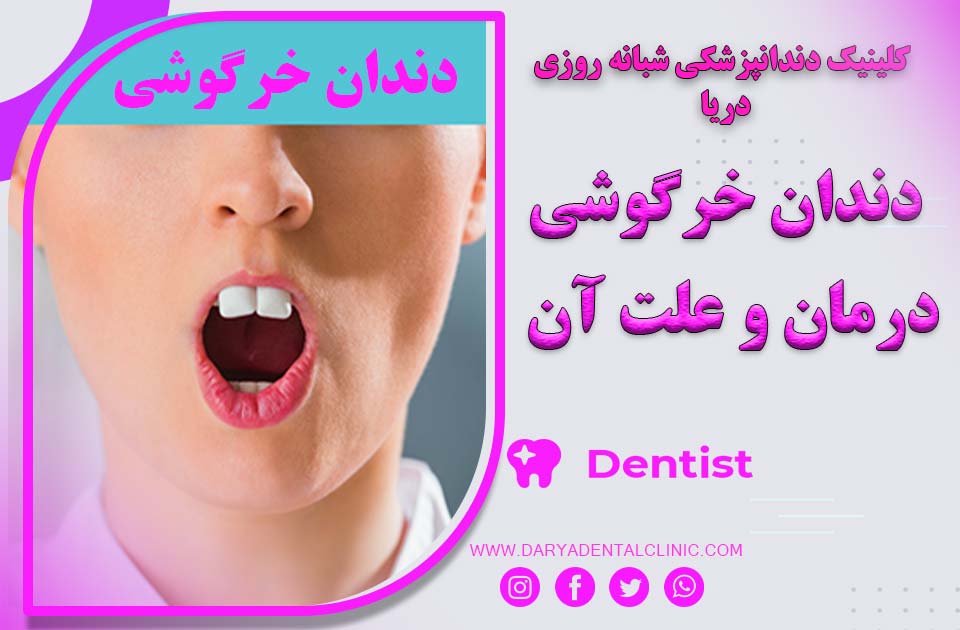 دندان خرگوشی ( درمان و علت آن )
