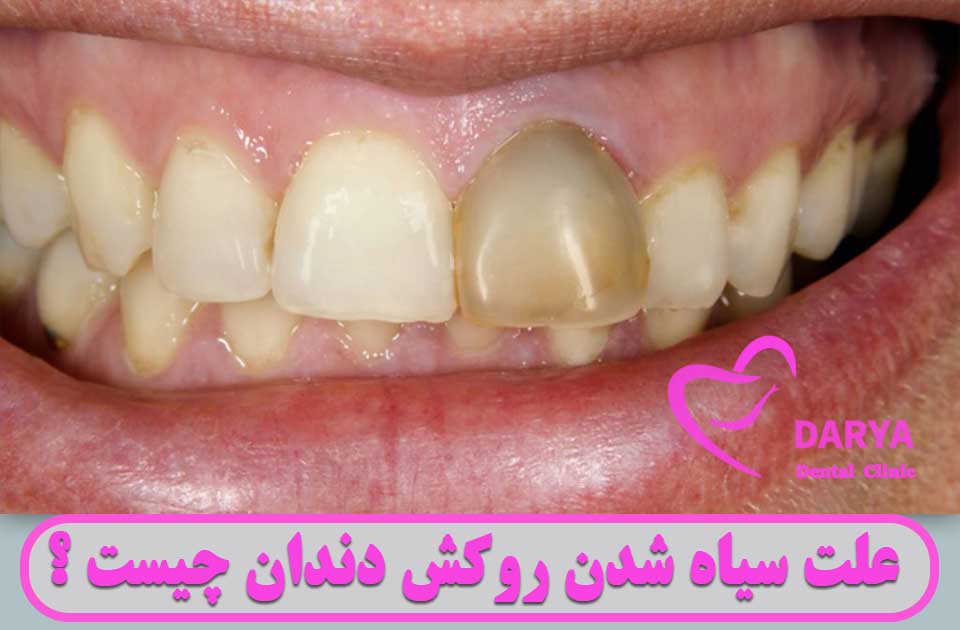 علت سیاه شدن روکش دندان چیست ؟