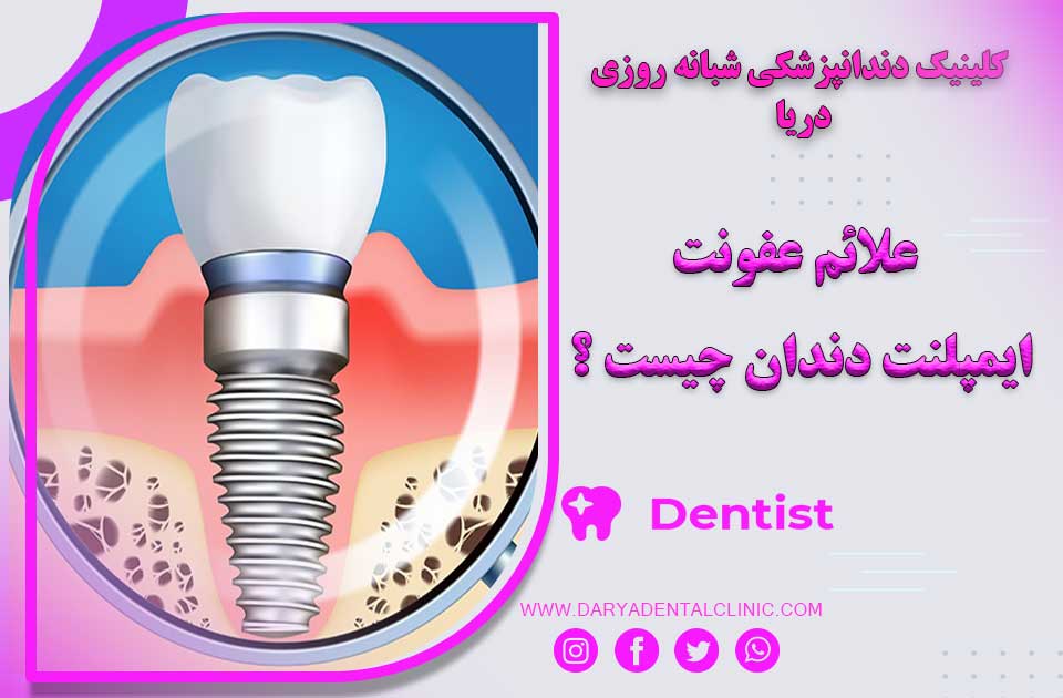 علائم عفونت ایمپلنت دندان چیست ؟