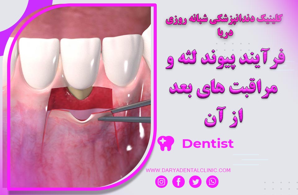 فرآیند پیوند لثه و مراقبت های بعد از آن
