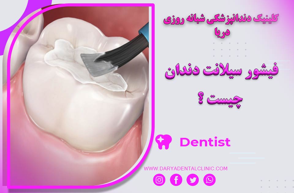 فیشور سیلانت دندان چیست ؟