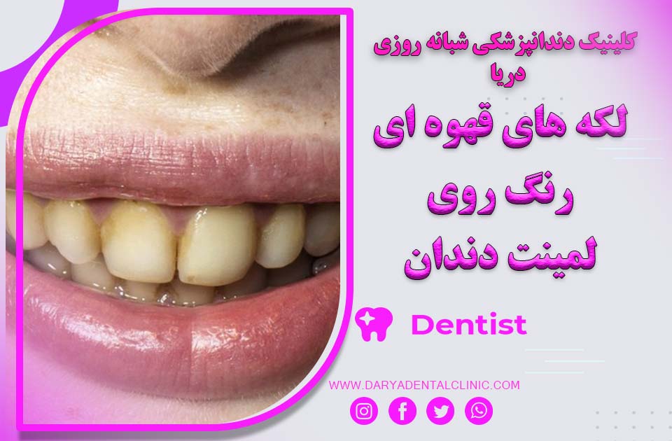 لکه‌ های قهوه ‌ای رنگ روی لمینت دندان