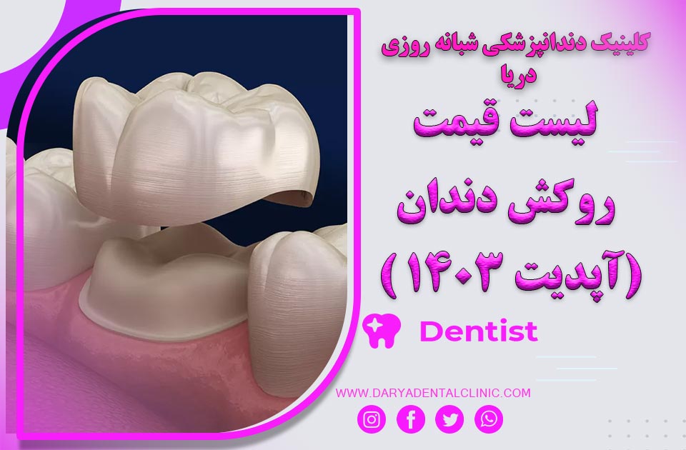 لیست قیمت روکش دندان جدیدترین آپدیت 1404 ( ارزان و معتبر )