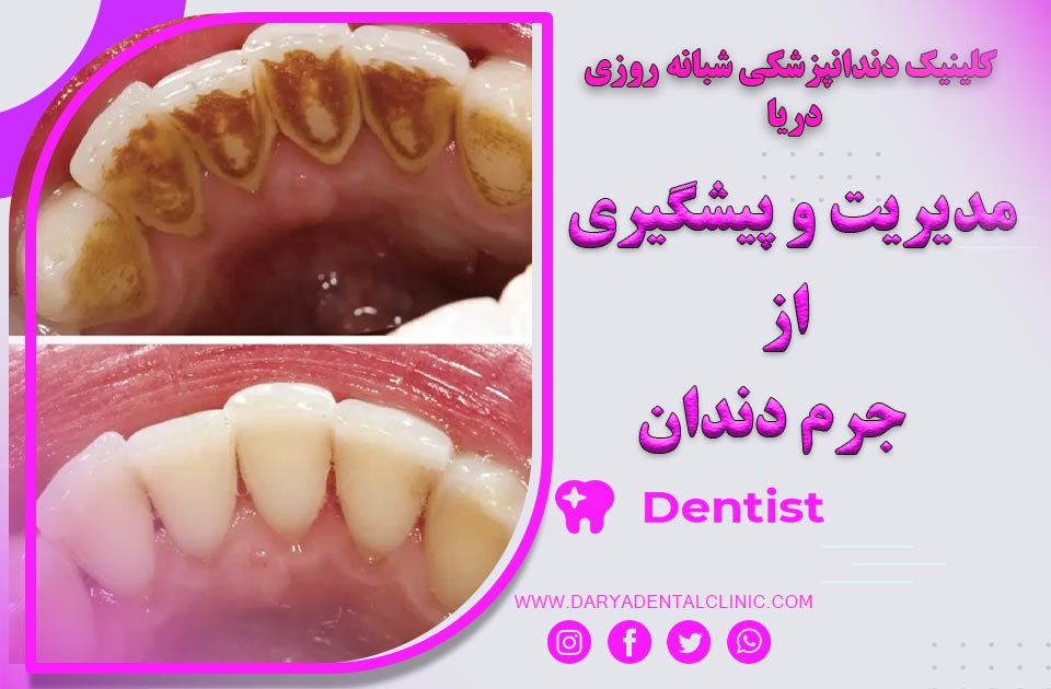 مدیریت و پیشگیری از جرم دندان ( راهکارها + اهمیت بهداشت دهان )
