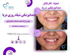 رفع نا مرتب بودن دندان ها