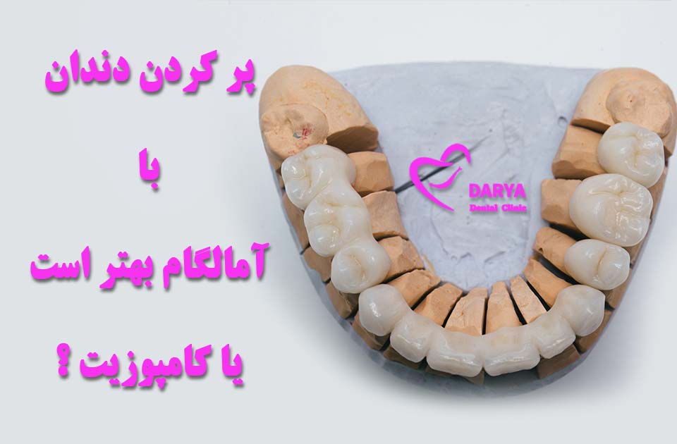 پر کردن دندان با آمالگام بهتر است یا کامپوزیت ؟