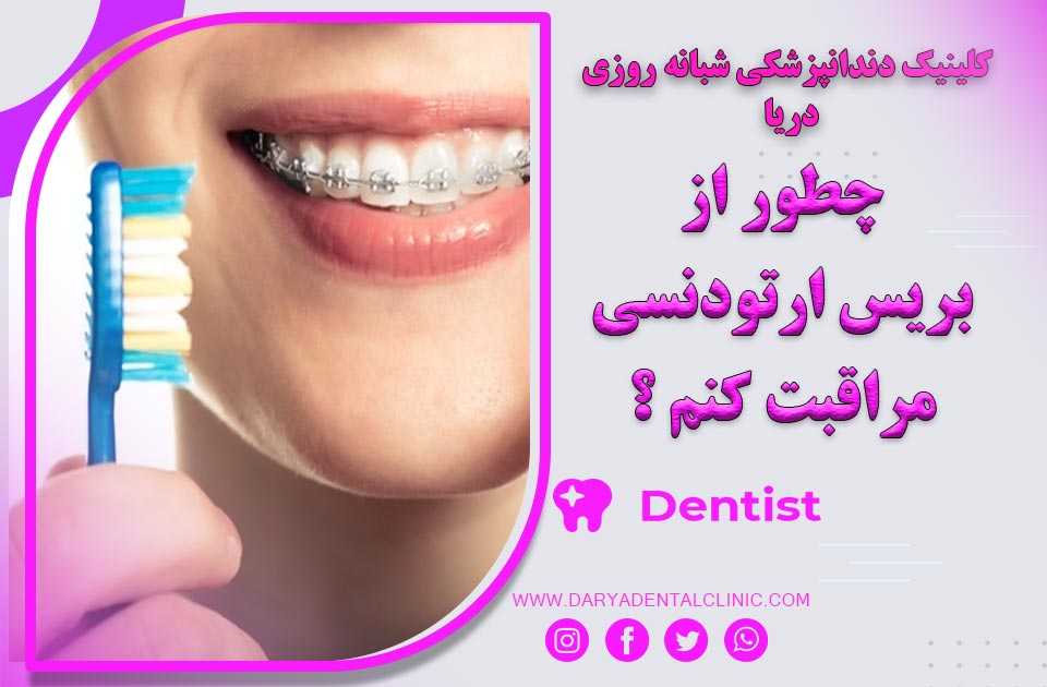 چطور می توانم از بریس ارتودنسی مراقبت کنم ؟ ( نکات مهم و ضروری )